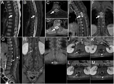 Imaging features of ALK-positive histiocytosis with neurological involvement: a case report and literature review